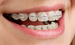Types of Braces : Your Premier Orthodontists in Texas : Orthodontist North  Richland Hills Hurst Euless Bedford Northeast Tarrant
